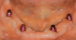 Fig 3. After abutment placement, the denture attachment housing with black retention processing ball was snapped onto the abutment and aligned to be parallel.