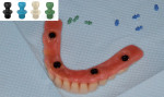 Fig 7. The provisional denture was trimmed and polished.