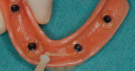 Fig 6. On removal, the provisional denture had picked up the attachment housings and black retention processing balls.