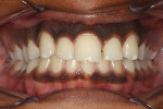 Patient presented with an oversized single central incisor and a desire for a more “normal” appearing smile.