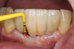 Bleeding on probing could be an indication
for peri-implant disease.