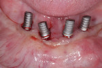 Lack of keratinized tissue can be noted, especially at mandibular right implants.
