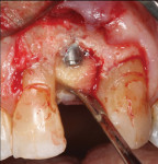 Surgical treatment included removal of the provisional restoration, placement of a cover screw, and grafting using a bovine xenograft and a collagen membrane with primary flap closure.