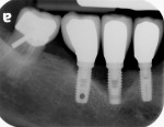 Radiographic appearance of different stages of peri-implant disease.
