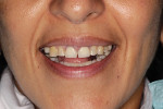 Photographs of existing dentition to be used for treatment planning.