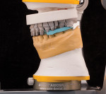Maxillary prepared arch mounted on mandibular provisional model.