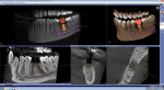 Galileos Implant Software makes it easy to plan and place implants with precision, safety,
and accuracy.