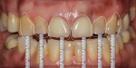 Fig 8. Revised smile design without anterior crown lengthening, per patient’s request.
