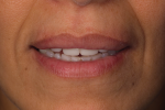 Fig 9. Provisionals showing incisal exposure with the lips at rest.