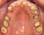 Fig 10. Dentition when final impressions taken.