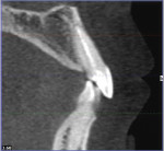 Fig 4. CBCT image of the nonrestorable tooth No. 9 showing the presenting thin facial plate and facially prominent root.
