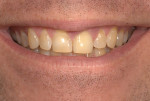 Fig 3. Preoperative full smile showing the amount of tooth and gingival display