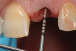 Fig 12. Placement of the delayed implant 3 mm apical to the planned CEJ.