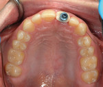 Fig 13. Occlusal view of the customized
impression pick-up.