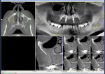 Fig 2. Pretreatment CT scan, right sinus, serial view.
