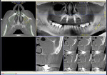 Fig 3. Pretreatment CT scan, left sinus, serial view.