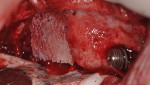 Fig 15. Stem cell cube graft placed into sinus defect right sinus region.