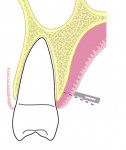 Fig 1. Coronal view of the palate at the level of maxillary first molar showing a single incision 2 mm from the gingival margin.