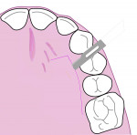Fig 2. Axial view of the palate showing an L-shaped incision 2 mm from the gingival margin.