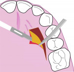 Fig 6. Axial view of the palate at the level of maxillary first molar showing a thick connective tissue graft being dissected from the raised palatal flap.