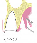 Fig 5. Coronal view of the palate at the level of maxillary first molar showing a thick connective tissue graft being dissected from the flap end.