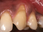 Fig 7.  Preoperative view of Miller’s Class I recession defect seen in tooth No. 11.
