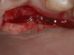 Fig 8. Thick SCTG being dissected from the palate.
