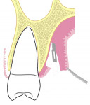Fig 3. Coronal view of the palate at the level of maxillary first molar showing a thick palatal flap elevation, leaving behind a thin connective tissue layer over the periosteum.