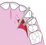 Fig 4. Axial view of the palate showing a thick palatal flap elevation, leaving behind a thin layer of connective tissue over the periosteum.