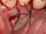 Fig 12. Palatal flap sutured back after the SCTG harvest with good primary closure.