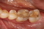Fig 1. Preoperative occlusal view of a posterior tooth that would be restored with a full-coverage zirconia restoration.