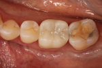 Fig 4. Occlusal view of an esthetic crown fabricated from a 550-MPa zirconia material.