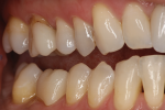 Fig 5. Buccal view of the same esthetic zirconia crown.