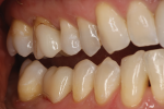 Fig 7. Buccal view of the same esthetic IPS e.max ZirCAD Multi restoration.
