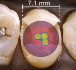 Fig 2 through Fig 4. Overlay of a beam profile on a MOD cavity preparation for a premolar and light diameters sized to demonstrate clinical conditions (hot spots: red, orange, yellow; cold spots: blue, violet). Fig 2: Light A premolar MOD preparation – The irradiance values over the proximal boxes are inadequate and the light tip does not cover the entire occlusal surface. Fig 3: Light B premolar MOD preparation – The irradiance values over the proximal boxes
are inadequate and the light tip does not cover the entire occlusal surface. Fig 4: Light C premolar MOD preparation – Note the uniform irradiance values with a “top hat” appearance, and coverage over the proximal boxes is very acceptable covering the entire occlusal surface.