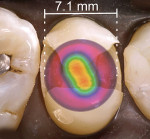 Fig 2 through Fig 4. Overlay of a beam profile on a MOD cavity preparation for a premolar and light diameters sized to demonstrate clinical conditions (hot spots: red, orange, yellow; cold spots: blue, violet). Fig 2: Light A premolar MOD preparation – The irradiance values over the proximal boxes are inadequate and the light tip does not cover the entire occlusal surface. Fig 3: Light B premolar MOD preparation – The irradiance values over the proximal boxes