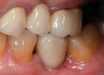 Fig 10. Full-contour zirconia implant crown seated intraorally.