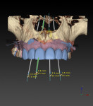 Initial digital planning with NobelClinician SmartFusion. The current tissue position (model) is rendered in pink, and the desired final tooth position (digital wax-up) is rendered in blue.