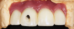 Screw-retained provisional restorations
refined on a model on the day of surgery.
