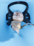 Using a minimally invasive approach, tooth No. 19 was prepared with supragingival margins.