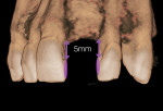 Fig 2. Example, frontal view of anterior maxilla showing measurement from crestal bone to gingival extent of interproximal contact to ensure papilla fill.