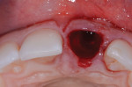 Fig 4. Atraumatic extraction of fractured tooth No. 9.