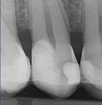 Fig 13. Radiograph taken immediately after direct pulp cap and crown build-up.