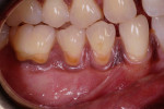 Fig 1. Teeth Nos. 28 through 30 were found to have gingival recession with NCCLs and gingival pigmentation in interdental papillae and a zone of keratinized gingiva.