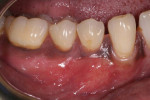 Fig 5. After 12 weeks of healing, nearly complete root coverage was achieved and the zone gingival pigmentation preserved.