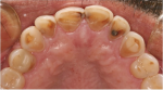 Fig 1 through Fig 3. Clinical examples of dental erosion in three different patients. Fig 1: retracted front view. Fig 2: occlusal view, upper arch. Fig 3: occlusal view, lower arch.