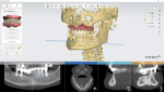 Fig 3. The dentist uses the impression data in combination with the CBCT data for digital planning.