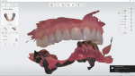 Fig 4. The dentist sends pre-operative digital impression scans as well as a standalone scan of the lower arch, showing the prepared teeth and abutments, to the laboratory.