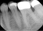Upon initial examination, loss of periodontal supporting tissue was noted on the distal aspect of tooth No. 19. Treatment was not performed at this time.
