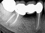 A 1-year, postoperative exam revealed a clinically normal tooth No. 29 with radiographic evidence of complete bony healing.